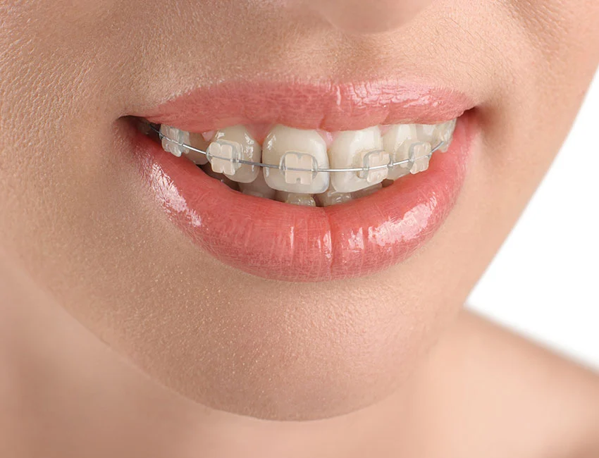 Orthodontics - Ceramic Braces