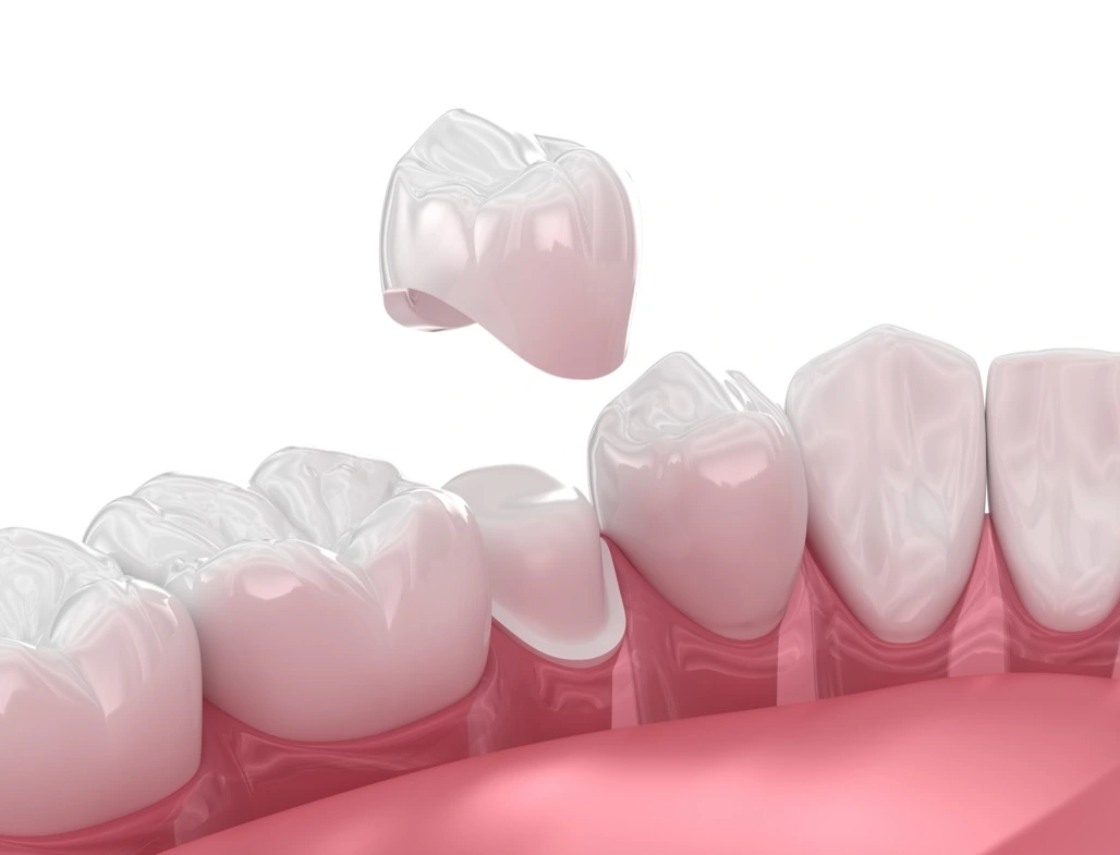 Dental Crowns helpful information