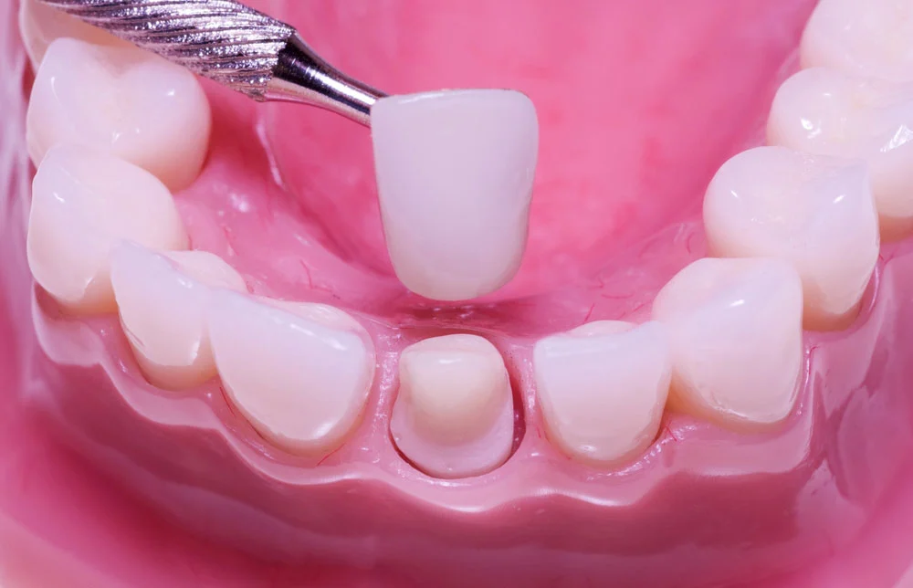 Placing dental crown on patient teeth