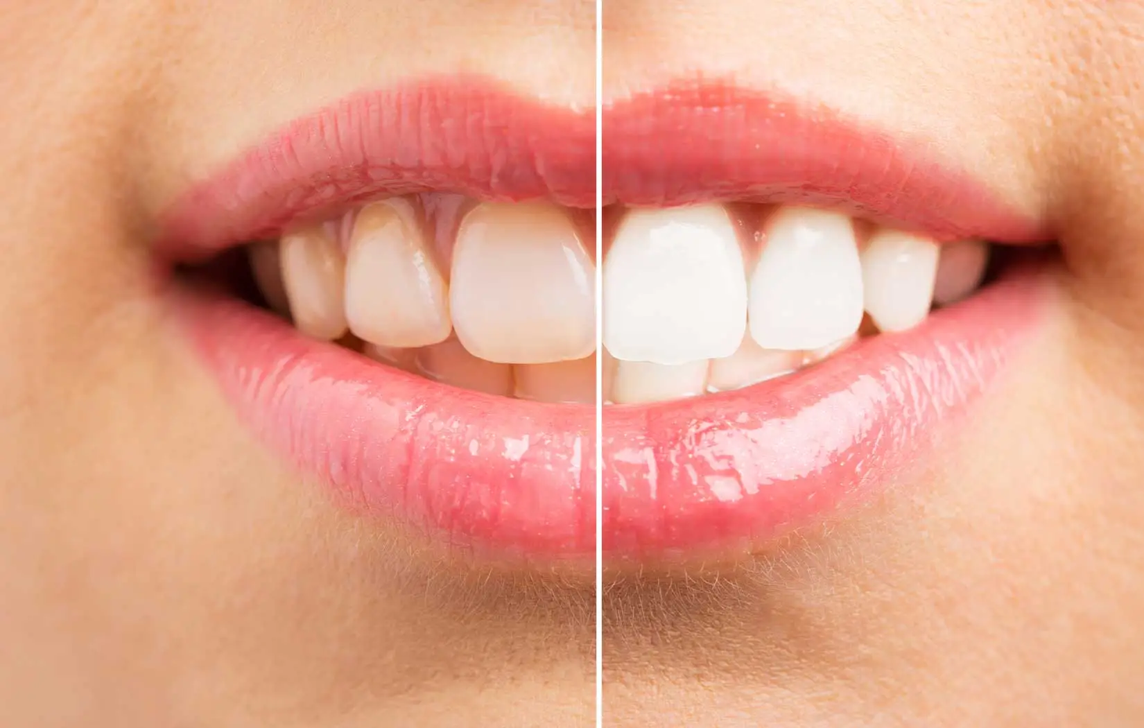 Before and after teeth whitening in San Juan Capistrano, CA